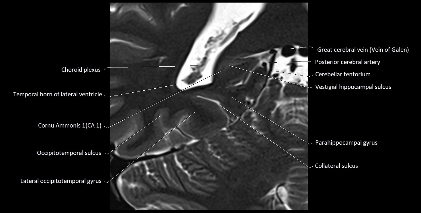 Hippocampus anatomy mri coronal cross section 3T MRI image 19.webp